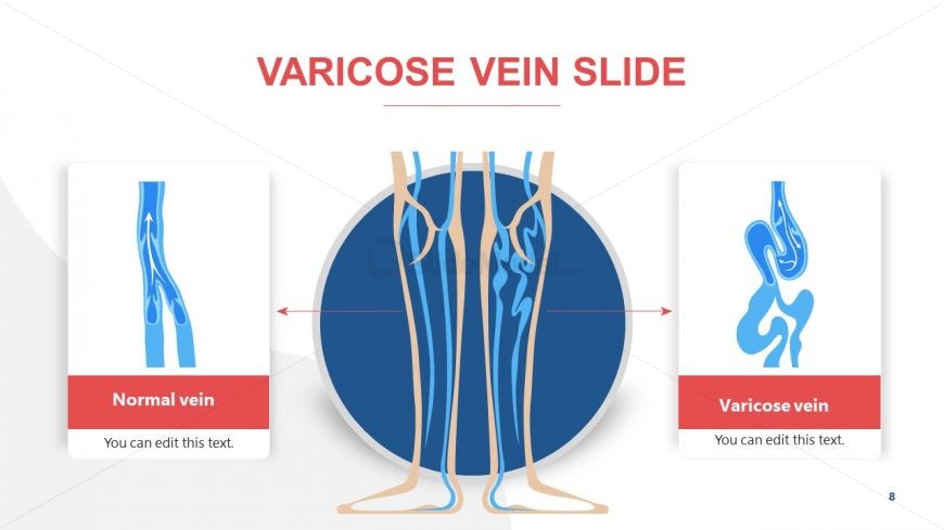 Presentation of Veins Disease Varicose 